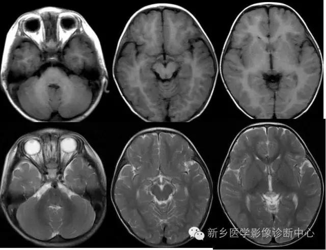 脱髓鞘样改变的mri表现,髓鞘形成稍延迟区