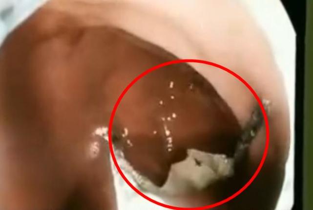 老伯误把6厘米铁丝当做梅干菜吃进肚里，致使食道穿孔险些丧命