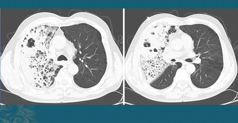 糖尿病肺炎克雷伯用什么抗生素,糖尿病足合并肺炎克雷伯菌感染