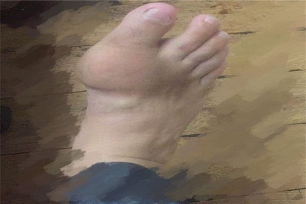 痛风急性发作脚疼怎么缓解,痛风脚痛怎么治最有效