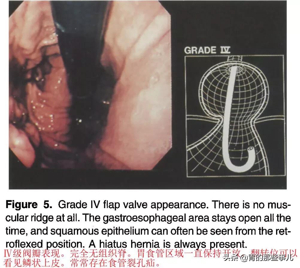 肠胃镜误区,揭秘胃镜检查的几大误区