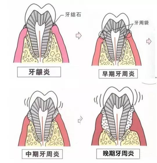 烤瓷牙的危害与副作用,全烤瓷牙有什么风险和后遗症