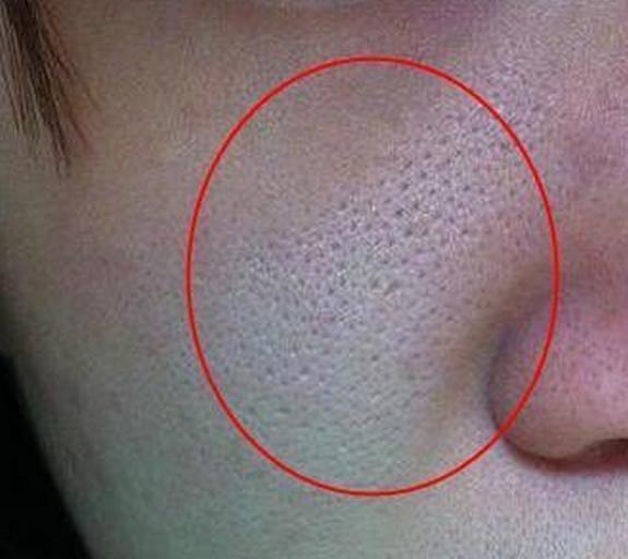 毛孔被油脂堵塞,毛孔被毛发堵塞