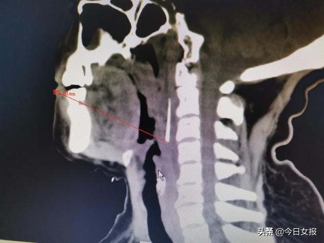 六旬老人喝汤吞下钢针分两次才取出！汤里竟藏着洗碗留下的钢丝球