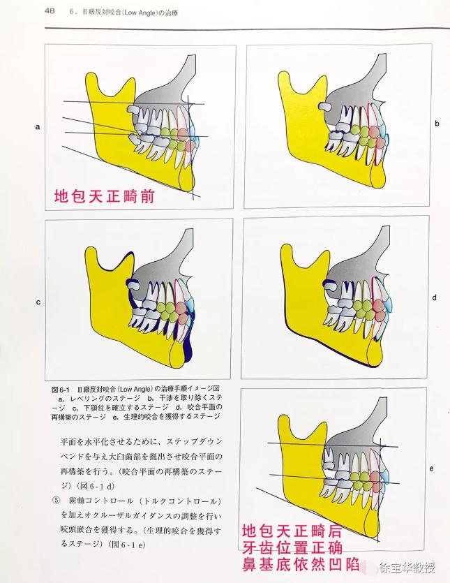 鼻基底严重法令纹很深怎么遮盖,鼻基底凹陷法令纹瘦下去会改善吗