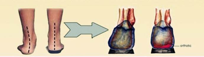 膝外翻的判定方法,足外翻导致膝外翻的最佳锻炼方法