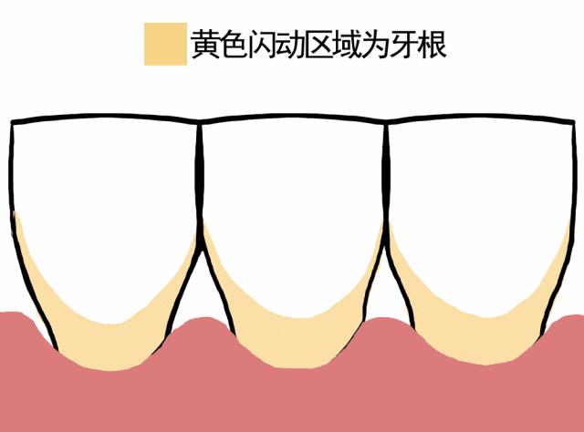 牙龈上有白色的牙垢刷不掉,牙龈里的黑东西