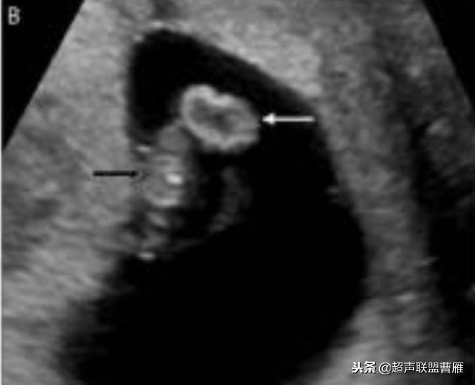 3毫米卵黄囊未见胎芽正常么,40多天的卵黄囊
