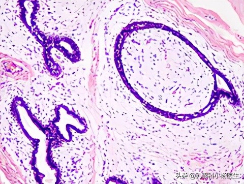 乳腺腺病伴纤维腺瘤会癌变吗,乳腺纤维腺瘤严重吗