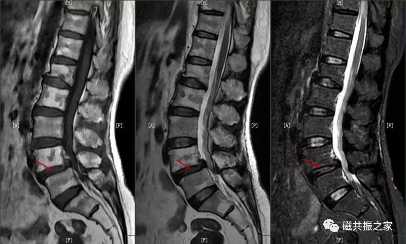 腰椎有哪些病变,腰椎病变有几种