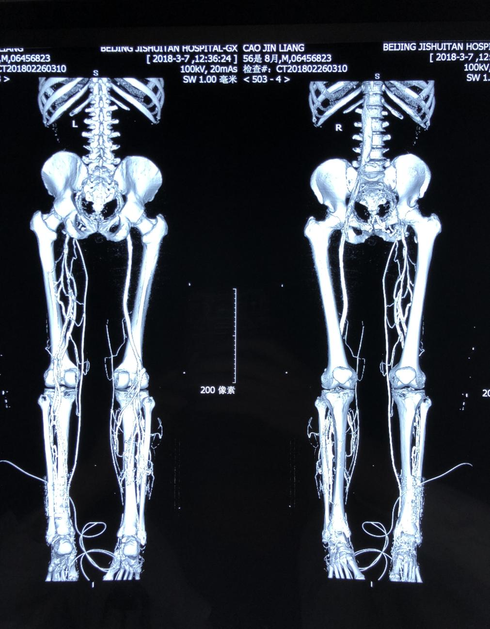 【科普创新月】“老烂腿”，我们应该怎么办？