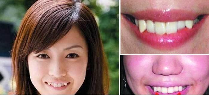 为什么人会长牙,为什么会有人长兔牙