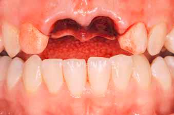 牙齿断了把牙根拔出,牙齿断了拿另一半能补吗