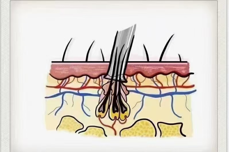 大家谈谈植发的经历,植发真的是一个漫长的过程