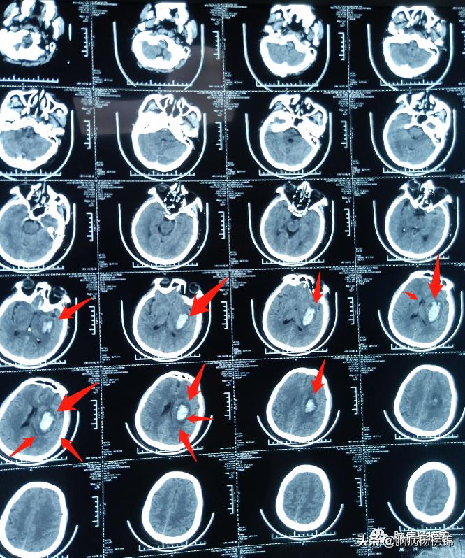 高处坠落4-6小时导致脑出血,高空作业会不会引起脑出血
