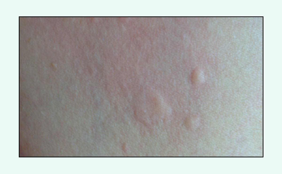 脸上的红疙瘩疼是什么原因,脸上的各种疙瘩