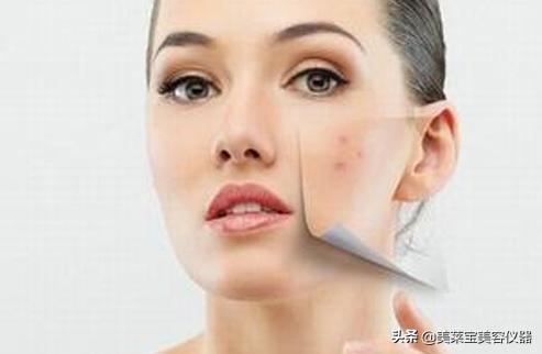 祛痘痘最好的仪器,美容除痘产品