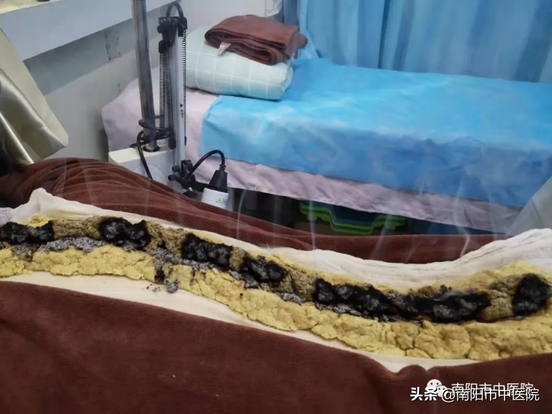 南阳市中医院开展多种中医特色治疗项目——虎符铜砭刮痧