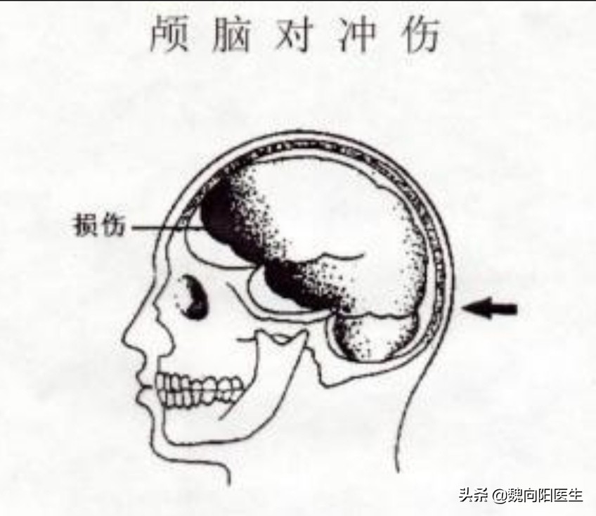 后脑勺着地可能出现什么症状,后脑勺着地算什么伤