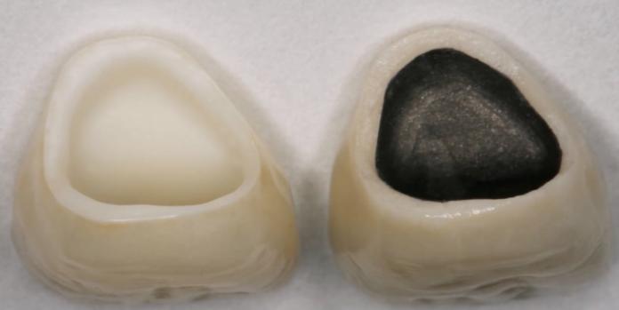 烤瓷牙贴片全口价格,贴片牙齿和烤瓷牙有哪些伤害