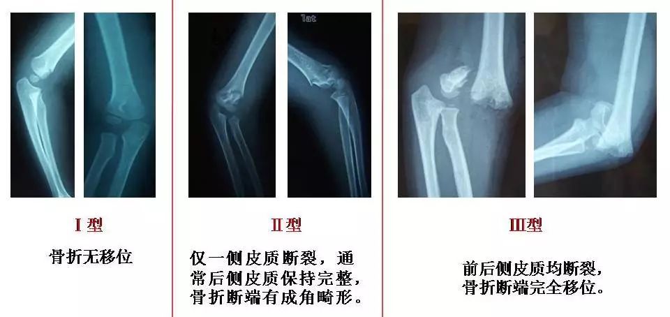 胳膊骨折三个月腿又骨折,孩子胳膊骨折好后还容易骨折么