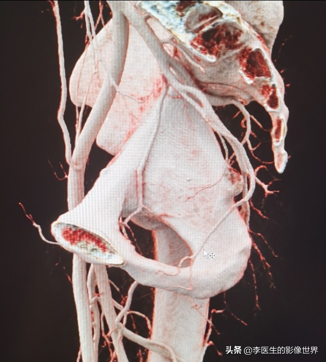 勃起功能障碍,ED之阴部内动脉CT血管成像