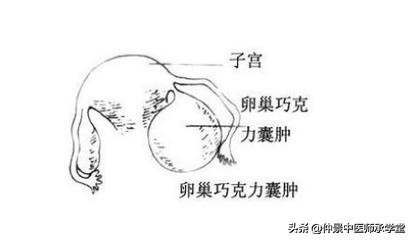 子宫内膜异位症久治不愈,还易复发?仲景千古名方效如桴鼓。