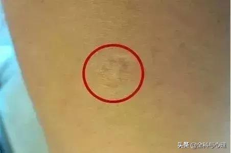 胳膊上莫名其妙的长疤怎么来的,胳膊上的疤是怎么来的