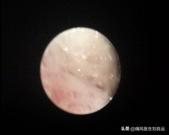 尿酸正常了可以手术取痛风石吗,痛风石可以做手术取掉吗