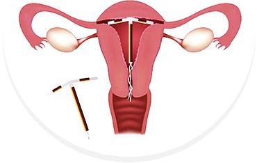 上环后月经推迟一周会不会怀孕,上环后月经会推迟多久呀