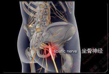 腰椎坐骨神经痛最快的康复方法,膝盖坐骨神经痛最快的康复方法