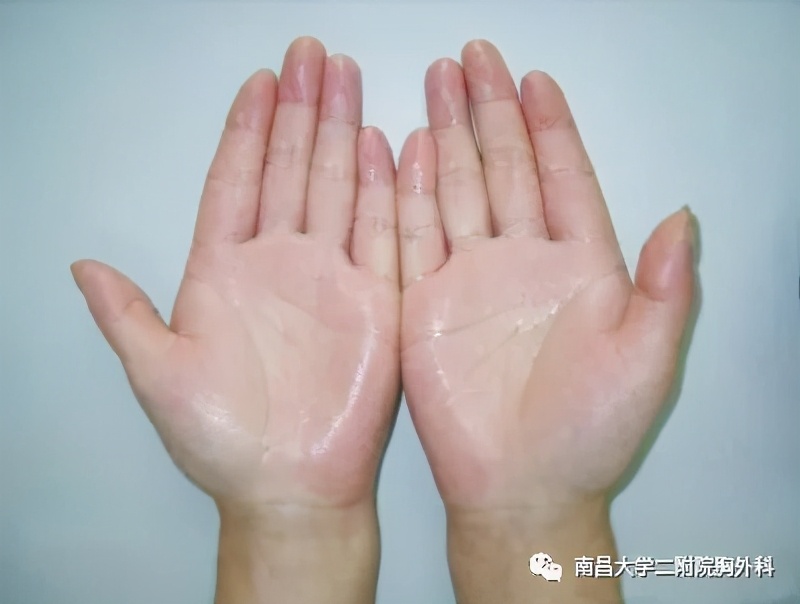 手汗症选哪个医院,手汗症大学科普