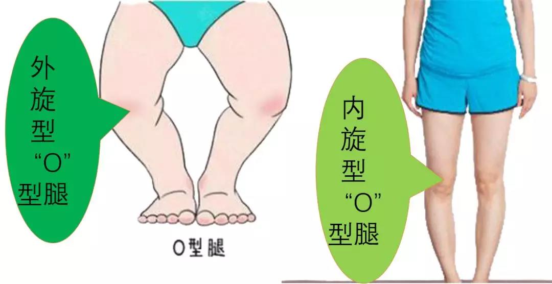 17岁xo型腿能矫正过来吗,x型腿o型腿能矫正吗