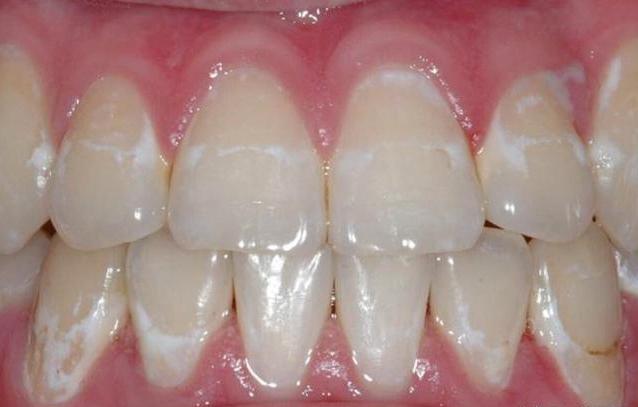 牙齿长白点到底是不是脱矿,牙齿出现白点该怎么办