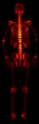 前列腺癌转移骨髓瘤治愈经验,前列腺癌骨转移抗癌成功案例