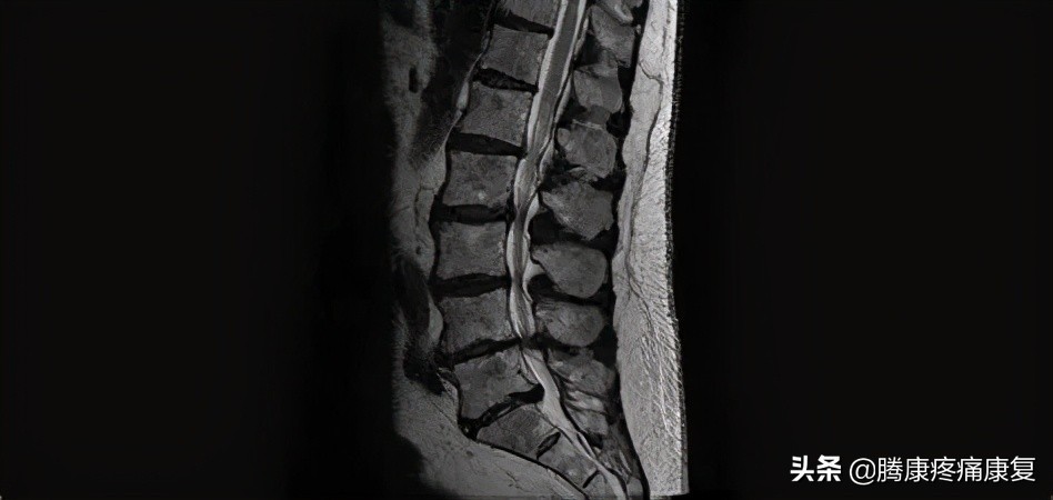 腰椎间盘退行性改变怎么治疗呢,腰椎退行性变和腰间盘突出哪个重