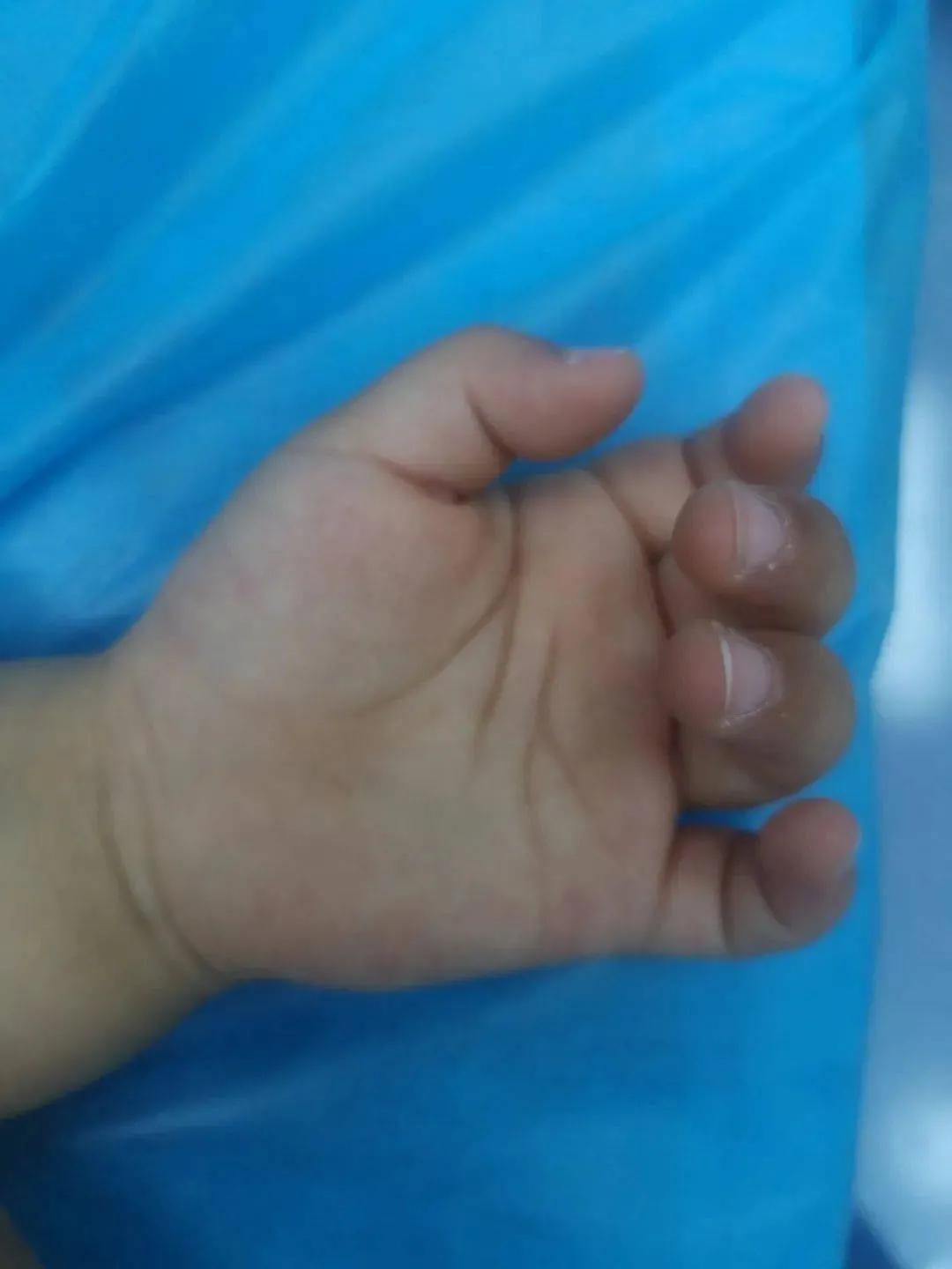 先天性腱鞘炎宝宝小拇指伸不直,小儿手指腱鞘炎不治疗的严重后果