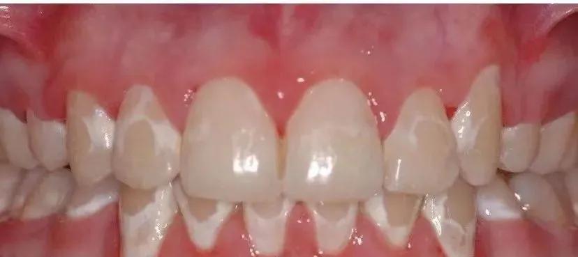 牙齿脱矿用含氟牙膏有用吗,一岁半宝宝牙齿脱矿怎么办