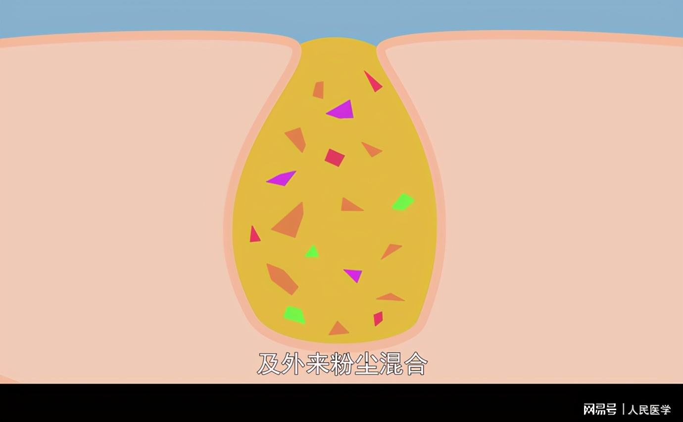 脸上出现像针孔大小的坑,脸上有很多像毛孔一样的坑怎么办