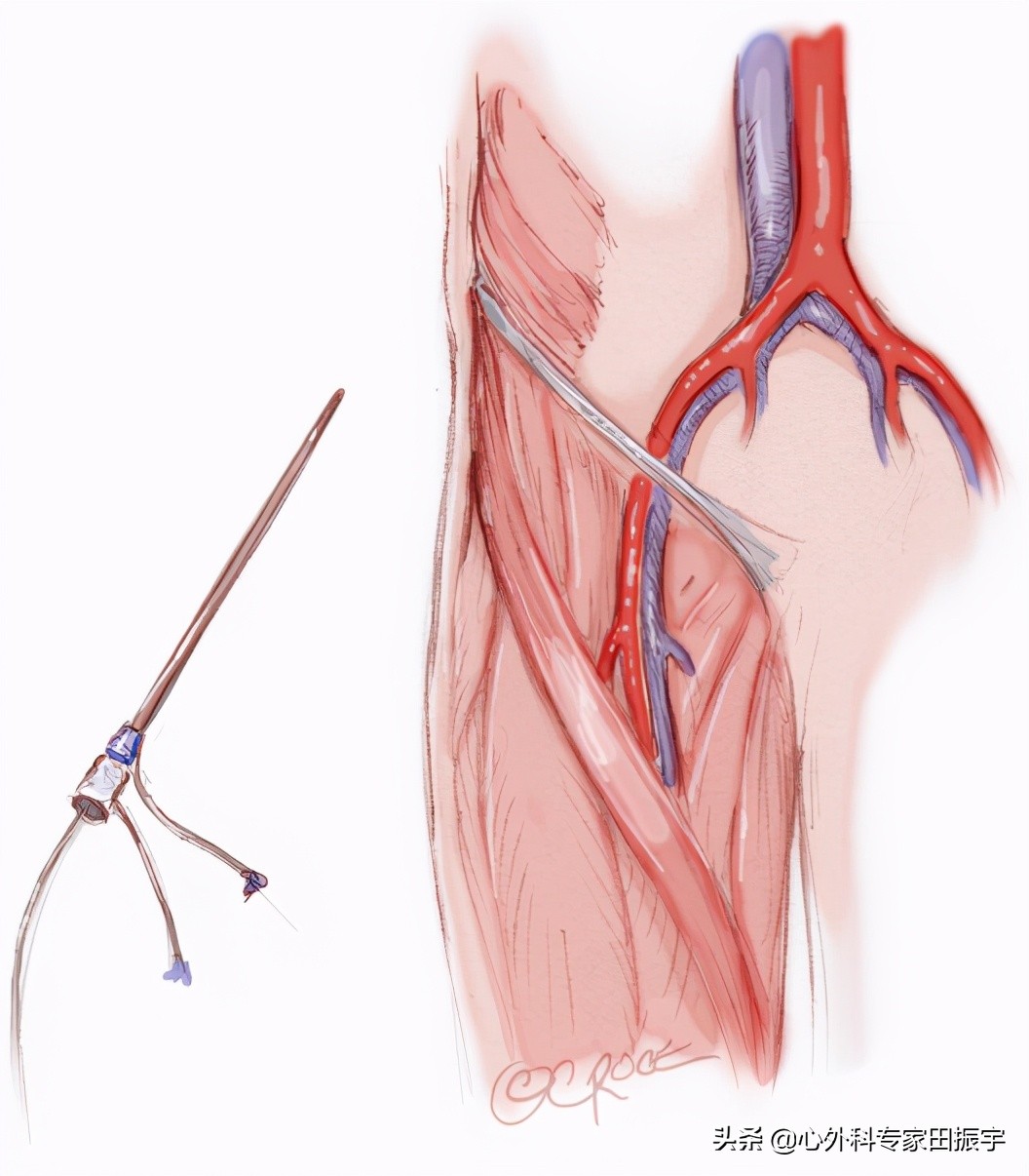 急性B型主动脉夹层合并主动脉破裂的急诊处理