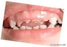 门牙马上要掉了怎么办,门牙连根掉了时间长还能安上吗
