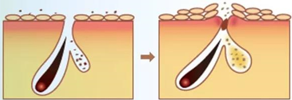 毛孔粗大显老,毛孔粗大显老焦虑