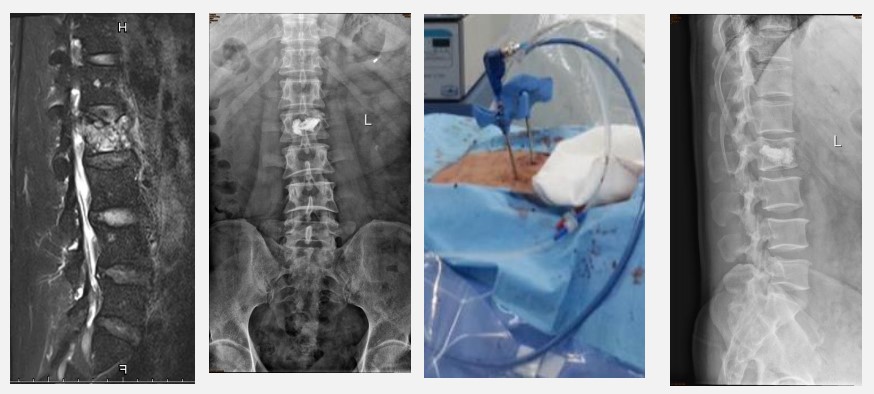 深入骨髓的痛!30年前不能治的骨转移,现在或有3个机会