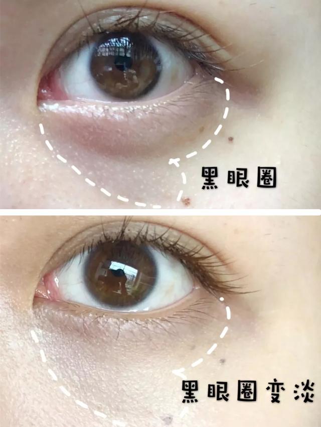 脂肪粒应该怎样用针挑,脂肪粒用针挑越挑越多