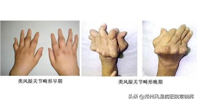 大家的类风湿都是怎样治愈的,类风湿性关节炎的几大认识误区