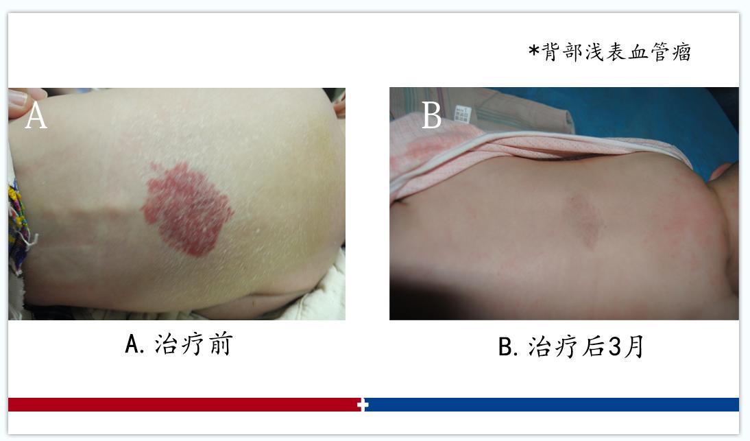 血管瘤复发的六大原因,血管瘤一直发作怎么回事