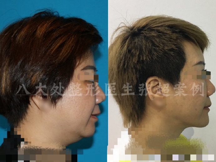 八大处整形张超,八大处张超最新视频