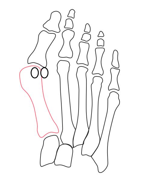拇外翻大脚趾疼如何在家就能治,如何判断拇外翻造成的脚疼