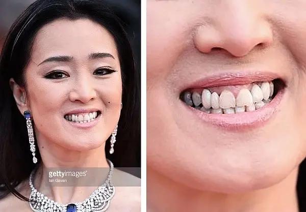明星都做了全烤瓷牙吗,明星做烤瓷牙是要拔掉原来的牙吗