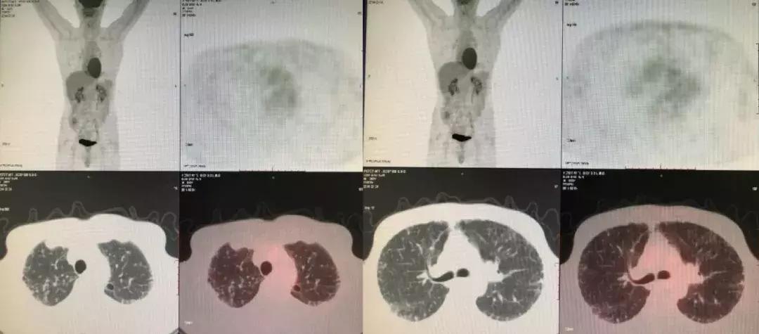 肺纤维化病例,肺纤维化手指甲发紫还能活多久